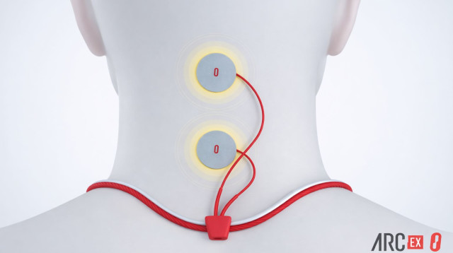 ARC-EX. גירוי עצבי מתקדם (צילום: איור: arc-ex)