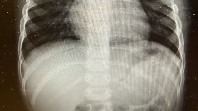 צילום רנטגן של בית החזה של הילד (צילום: דוברות מרכז רפואי "מאיר" מקבוצת "כללית")