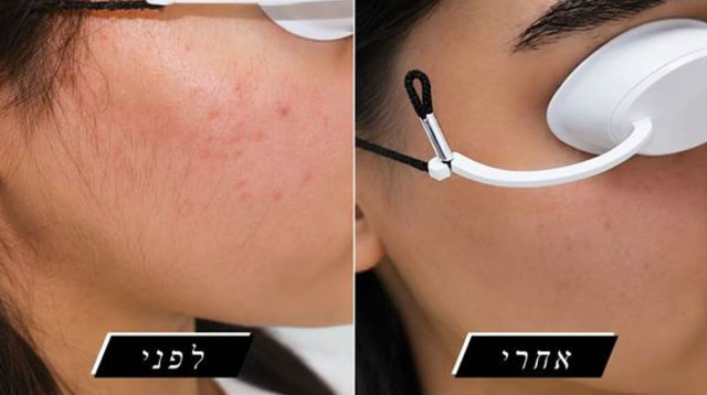 הטכנולוגיה שכובשת את עולם הסרת השיער הגיעה ללוד (צילום: יחצ)