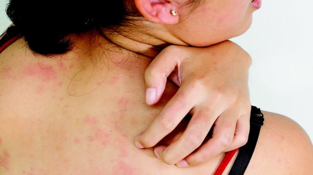 אישה מגרדת בגלל פריחה  (צילום: אינגאימג)