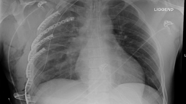 צילום חזה לאחר ניתוח (צילום: יח"צ)