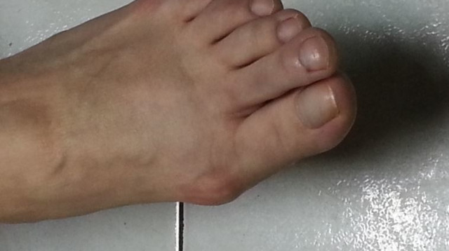 רגל עם הלוקס ולגוס (צילום: אילוסטרציה)