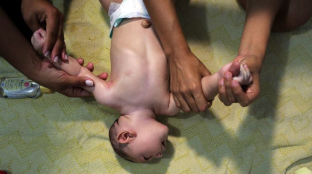 ילד הסובל מתסמיני זיקה, ברזיל (צילום: רויטרס)