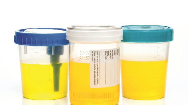 בדיקת שתן (צילום: אילוסטרציה: אינג אימג')