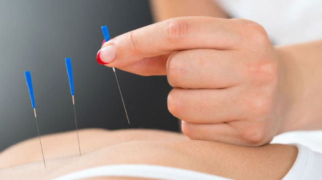 דיקור סיני  (צילום: Bigstockphoto)