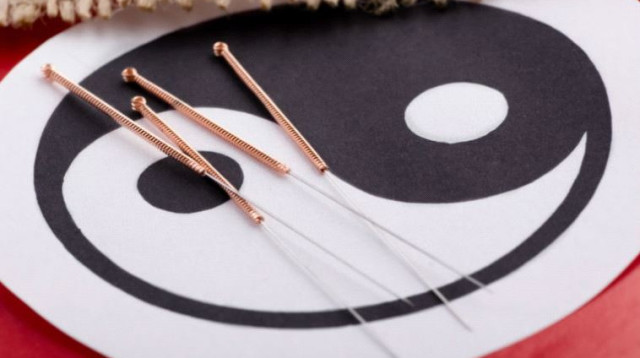 דיקור (צילום: Bigstockphoto)