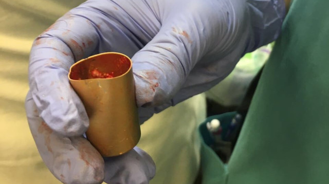 פקק הבושם שבלע הפעוט בצפון (צילום: המרכז הרפואי לגליל)