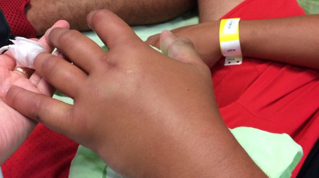 היד של רותם ריעני לאחר שהוכש ע"י נחש (צילום: דוברות בית חולים איכילוב)