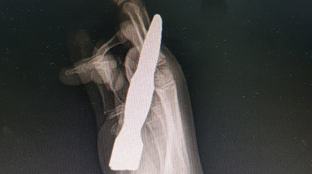 צילום של כף היד (צילום: מרכז רפואי העמק)