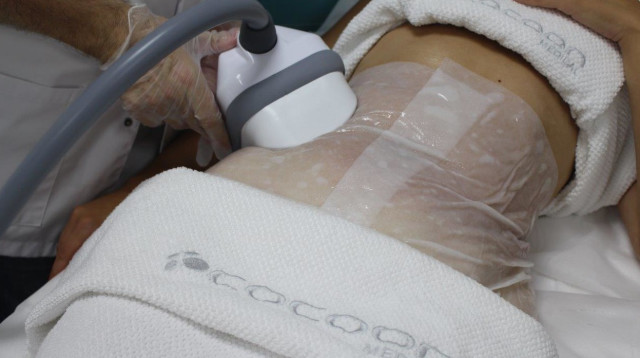 הקפאת שומן (צילום: יח"צ)