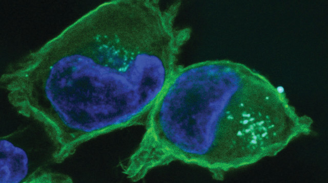 תאים נגועים בסרטן הלבלב (צילום: הדס גיבורי, אוניברסיטת תל אביב)
