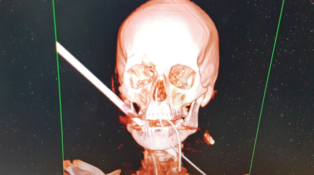 חץ פלדה נתקע בפניו של צעיר (צילום: אלי דדון)