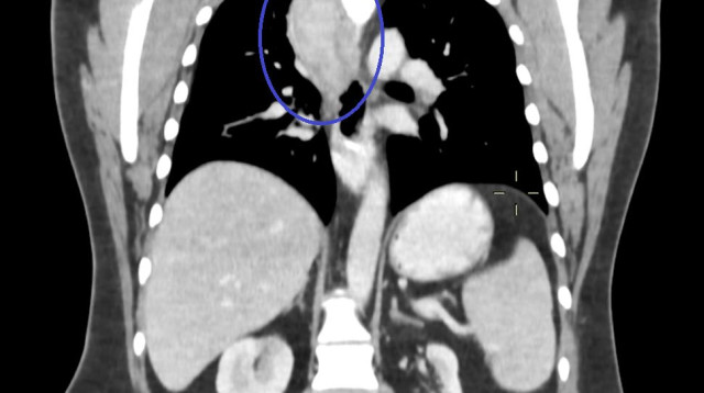 הוושט לפני הניתוח (הגידול מוקף בעיגול) (צילום: בית החולים קפלן)