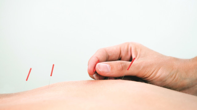 דיקור (צילום: אינג אימג')