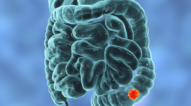 סרטן מעי גס (צילום: הדמייה: bigstockphoto.com)