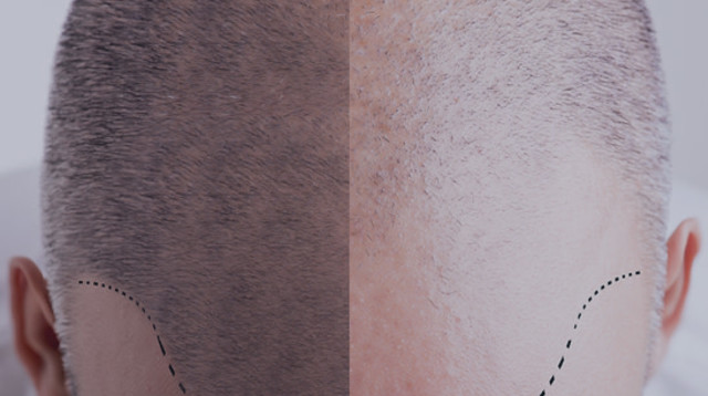 השתלת שיער (צילום: יח"צ)