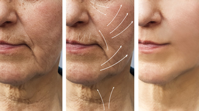 העלמת קמטים (צילום: BIGSTOCK)