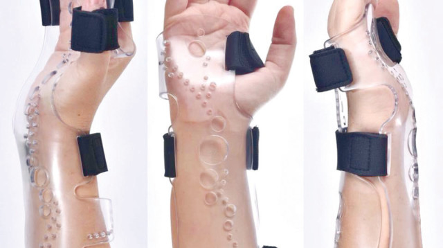 הגבס השקוף. פיתוח פורץ דרך (צילום: CASSIT)