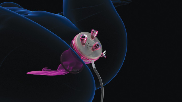 הדמיית הניתוח (צילום: applied medical)