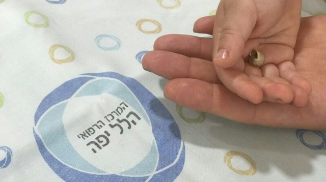 החילזון שנשלף מאפו של פעוט (צילום: המרכז הרפואי הלל יפה)