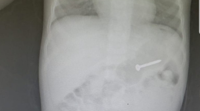 קטין בלע בורג (צילום: המרכז הרפואי אסף הרופא)