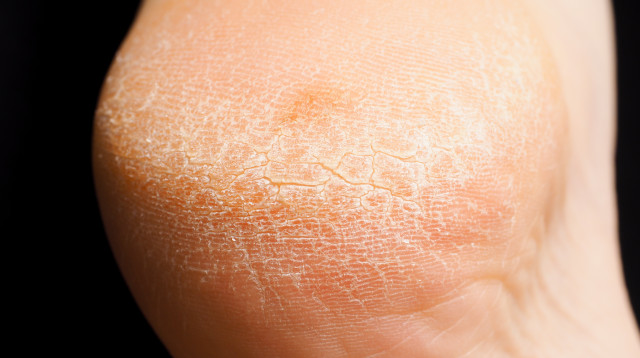 עור יבש (צילום: אינג אימג')