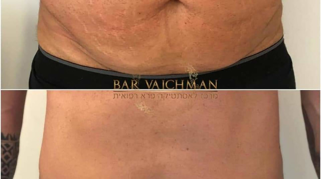 הקפאת שומן ע"י THR CRYO - קליניקת בר ויכמן  (צילום: בר ויכמן - קליניקה לאסתטיקה)