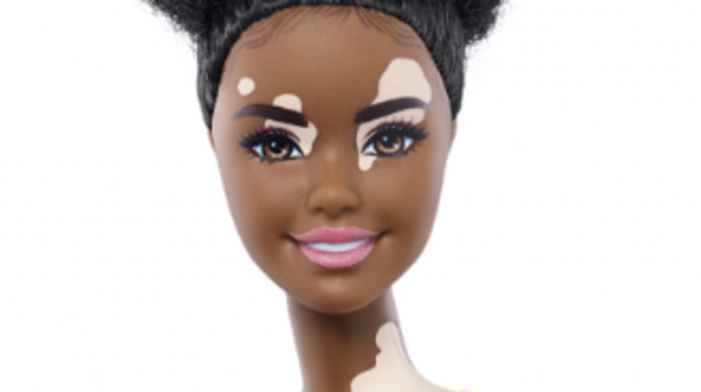 ברבי עם מחלת ויטליגו (צילום: מאטל)