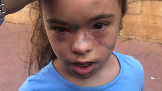 הילדה שהותקפה בצהרון בית הספר בבני ברק (צילום: צילום מסך מתוך הפייסבוק)