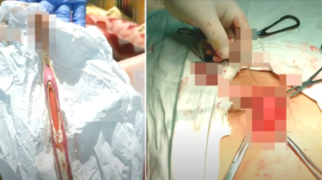 גבר בלע מברשת שיניים בזמן צחצוח (צילום: רשתות חברתיות)