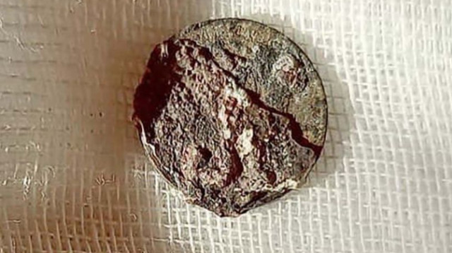 המטבע שנמצא בתוך אפו של המטופל (צילום: City Clinical Hospital named after M. Konchalovsky)