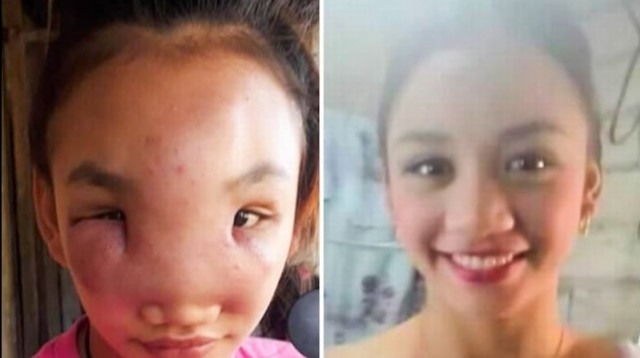 מרי אן ראצ'ו, הצעירה שחלתה במחלה מסתורית  (צילום: רשתות חברתיות)