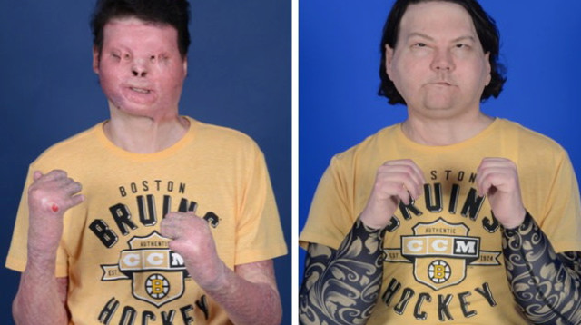 לפני ואחרי, הניתוח להשתלת פנים הראשון בעולם (צילום: רויטרס)