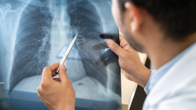 צילום רנטגן ריאות, אילוסטרציה (צילום: gettyimages)