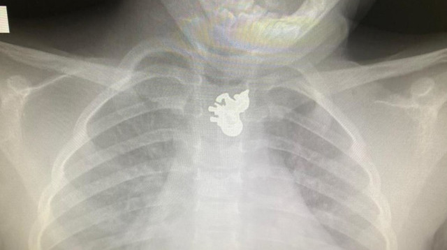 צילום הרנטגן של בת ה-3 (צילום: המרכז הרפואי קפלן)