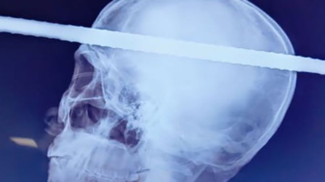 מוט ברזל חצה את הגולגולת של פועל בניין (צילום: Flores Hospital)