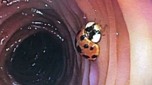 חיפושית גרה בתוך המעי הגס של מטופל (צילום:  American College of Gatroenterology)