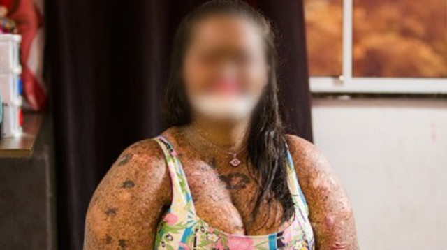 קרינה דה סוזה, האישה שעברה יותר מ-200 ניתוחים (צילום: Getty images)