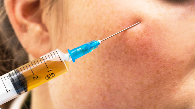 הזרקת בוטוקס, אילוסטרציה (צילום: ingimage ASAP)