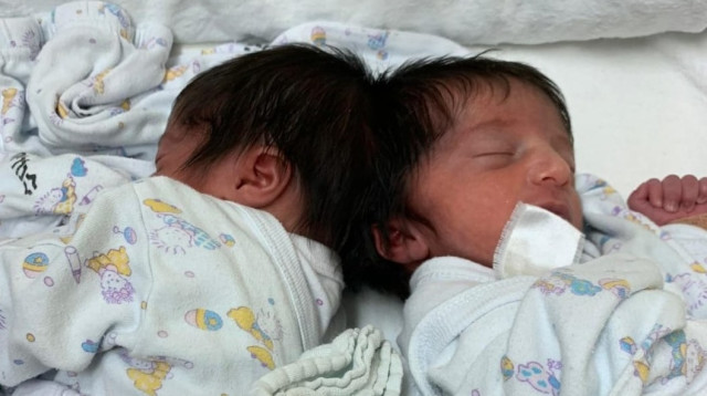 התאומות המחוברות בראשן (צילום: דוברות בית החולים סורוקה)