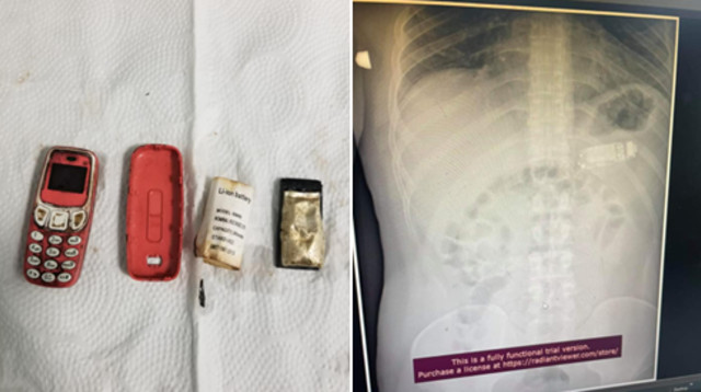 בן 33 בלע טלפון נוקיה (צילום: Klinika e Gastroentetologjisë)