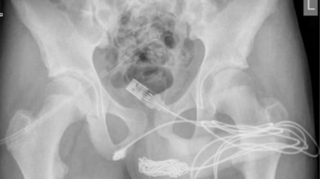 ניסה למדוד את איבר מינו באמצעות כבל USB (צילום: Urology Case)