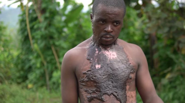 מוגביריגירה ז'אן קלוד סבל מכוויות חמורות (צילום: Getty images)