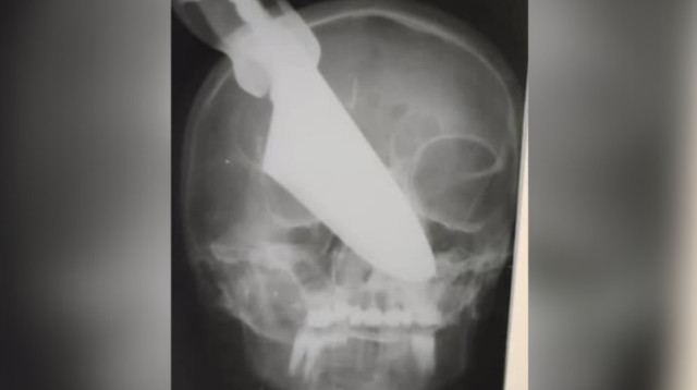 הסכין חדרה את הגולגולת  (צילום: Ministry of Health of Krasnodar)