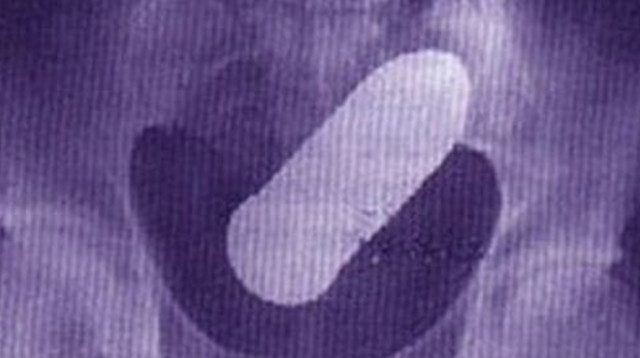 צילום אולטרסאונד של הפגז בגופו של המטופל (צילום:  Gloucester Hospital)