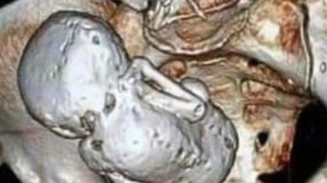 תינוק בן 40 אותר בבטנה של בת 84 (צילום: Reddit)