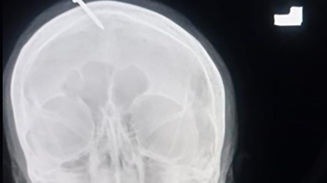 המסמר שהוחדר לראשה של ההריונית  (צילום: LADY READING HOSPITAL)