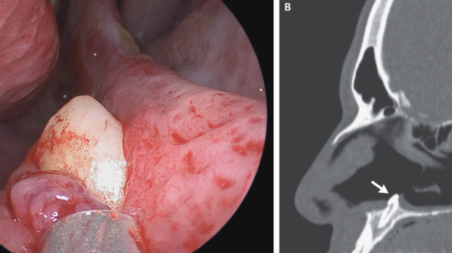 שן צמחה על רצפת הנחיר הימיני של המטופל (צילום:  The New England Journal of Medicine )