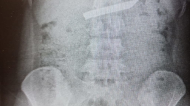 צילום רנטגן, בו ניתן לראות את להב הסכין בבטן העליונה  (צילום: דוברות המרכז הרפואי לגליל)
