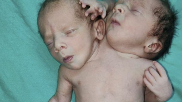 זוג התאומים התגלה כתינוק אחד עם שני ראשים ושלוש זרועות (צילום: Ratlam hospital)